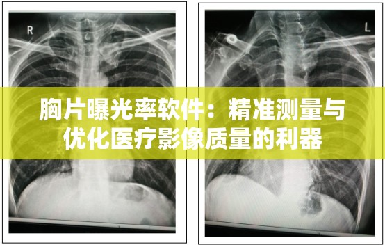 胸片曝光率软件：精准测量与优化医疗影像质量的利器